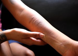 Селфхарм: помощь подросткам в клинике Анима